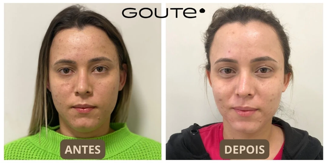 Acne-Of e Peeling
