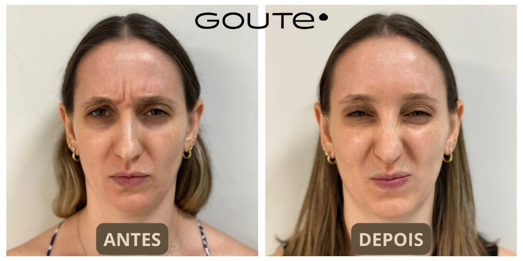 Botox