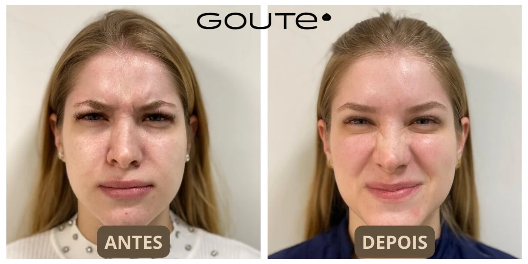 Botox