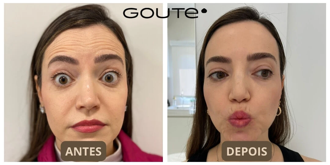 Botox