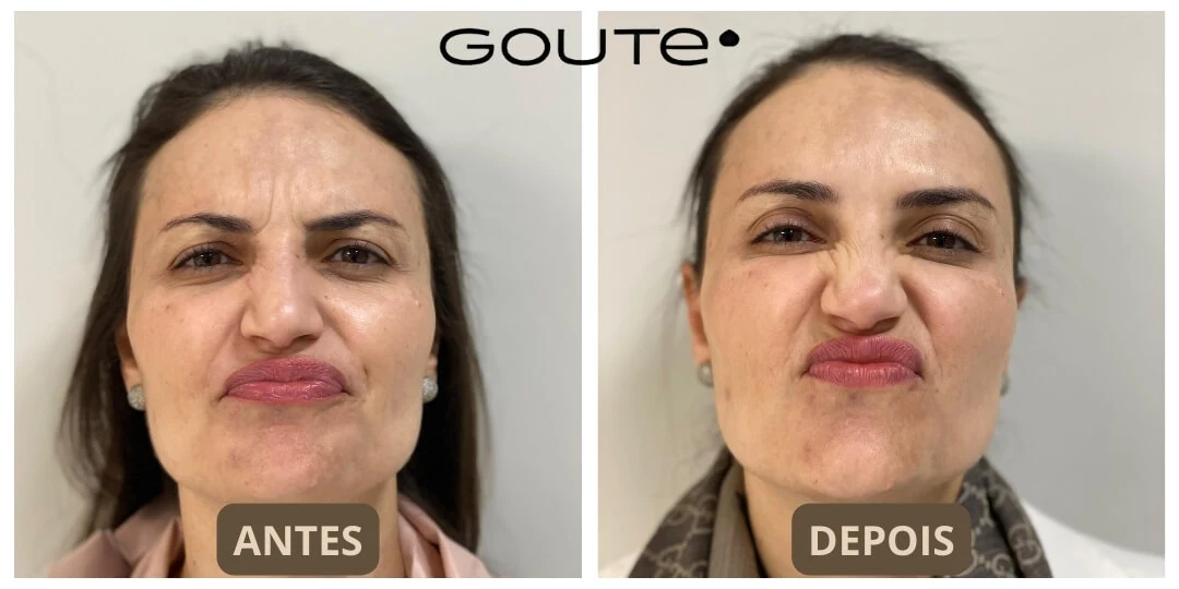Botox
