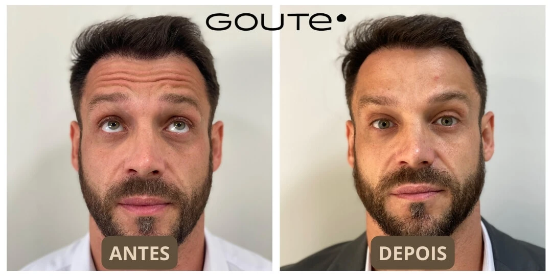 Botox