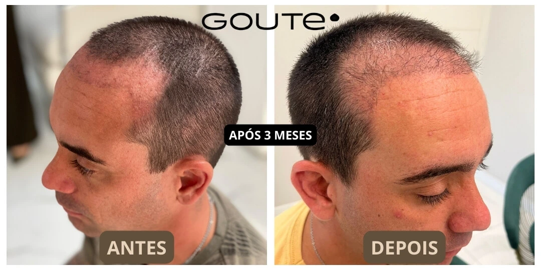Implante Capilar