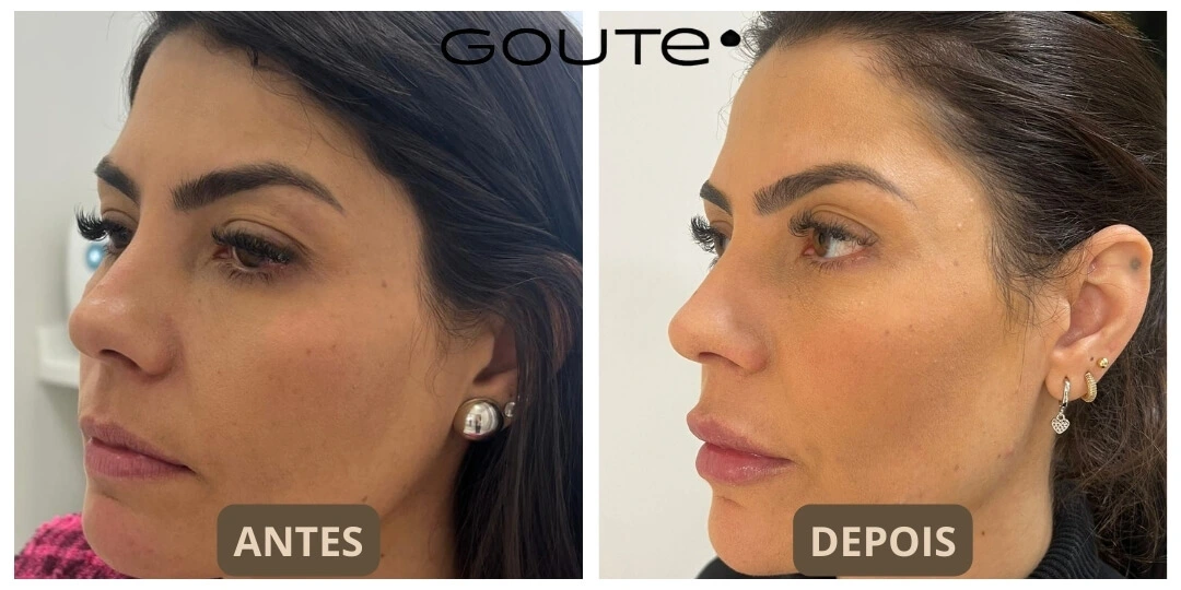 Preenchimento Labial